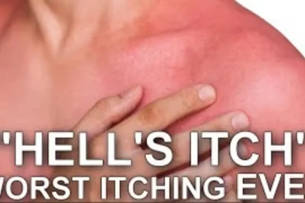How to Get Rid of Hell's Itch: Causes, Symptoms, and Treatments